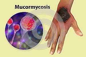 Cutaneous mucormycosis, a disease caused by fungi Mucor, also known as black fungus