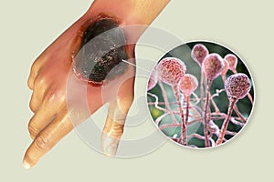 Cutaneous mucormycosis, or skin mucormycosis, a disease caused by fungi Mucor