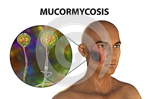 Cutaneous mucormycosis, or skin mucormycosis, a disease caused by fungi Mucor, also known as black fungus