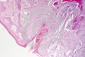 Cutaneous squamous cell carcinoma