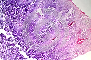 Cutaneous squamous cell carcinoma, light micrograph