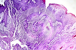 Cutaneous squamous cell carcinoma, light micrograph