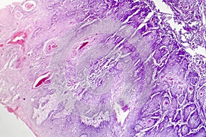 Cutaneous squamous cell carcinoma photo