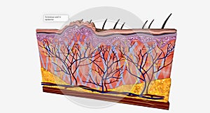 Cutaneous warts affect the outermost layer of skin (epidermis