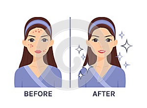 Cute brunette woman with pimples on her face. Acne Treatment. Before after. Problematic and clear skin. Healthy happy lady.