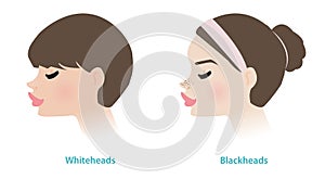 Cute women with whiteheads and blackheads acne on noses vector illustration.