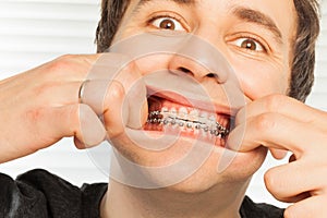 Cute young man with orthodontic braces photo