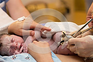 Cutting of the umbilical cord on a newborn baby