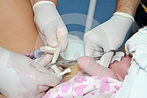 Cutting the umbilical cord between a newborn baby and placenta.