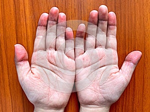Cyanotic hands or peripheral cyanosis or blue hands at Asian child with congenital heart disease