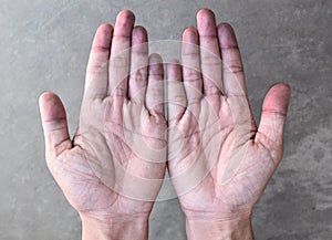 Cyanotic hands or peripheral cyanosis or blue hands at Asian man