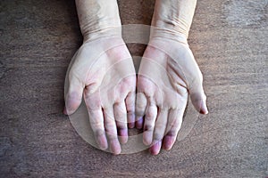 Cyanotic hands or peripheral cyanosis or blue hands at Asian old woman with congenital heart disease