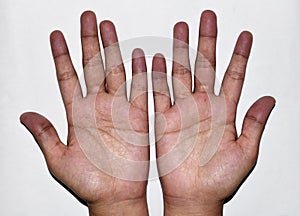 Cyanotic hands or peripheral cyanosis or blue hands at Asian young woman with congenital heart disease