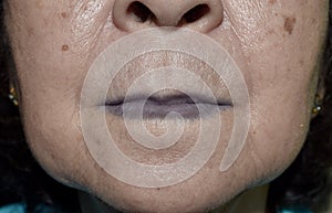 Cyanotic lips or central cyanosis at Southeast Asian old woman