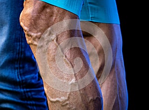 Cyclist legs with varicose and protruded veins