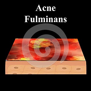 Cyst acne. furuncle Acne on the skin cysts and pimples. Dermatological and cosmetic inflammatory diseases on the skin of