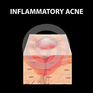 Cyst acne. furuncle Acne on the skin cysts and pimples. Dermatological and cosmetic inflammatory diseases on the skin of