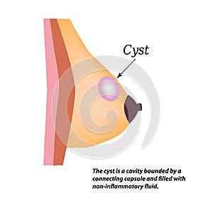 Cyst in the mammary gland. World Breast Cancer Day. Vector illustration on isolated background