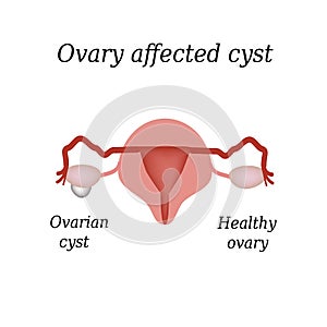 A cyst in the ovary. Pelvic organs. Vector