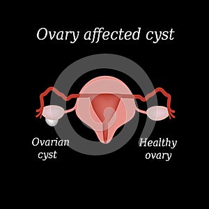 A cyst in the ovary. Pelvic organs. Vector