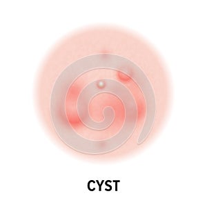 Cyst skin acne type vector icon. Skin disease acne cyst pimples type and face pore comedones photo