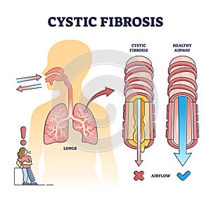 Cystic fibrosis disorder or healthy airflow airway comparison outline diagram