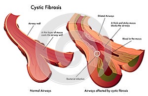 Cystic fibrosis