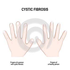 Cystic fibrosis. Nail clubbing Symptoms