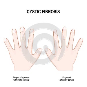 Cystic fibrosis. Nail clubbing Symptoms photo