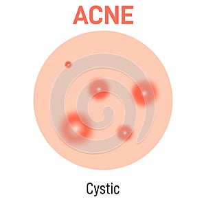 Cystic skin acne type