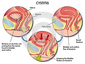 Cystitis