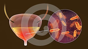 Cystitis, bacterial infection of urinary bladder