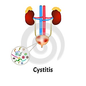 Cystitis. Inflammation of the bladder. The structure of the kidneys and bladder. Excretory system. Infographics. Vector