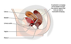 Cystocele