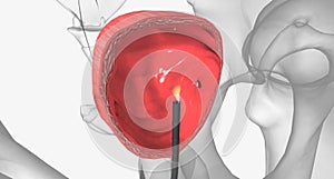 Cystoscope Exploration, It can be used to look for causes of signs or symptoms in the bladder or to look for an abnormal area seen