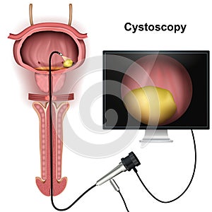Cystoscopy of the bladder 3d  illustration on white background