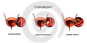 Cystoscopy of the bladder. stones and polyp.