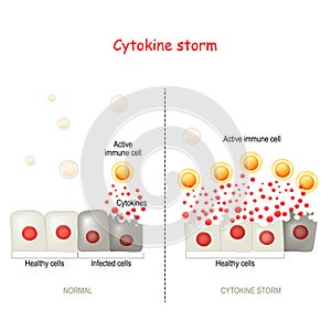 Cytokine storm or hypercytokinemia. COVID-19 complications