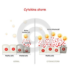 Cytokine storm or hypercytokinemia. COVID-19 complications photo