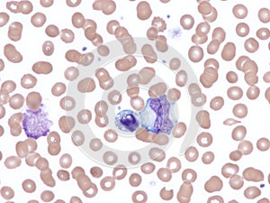 Cytomegalovirus infection. Peripheral blood smear.