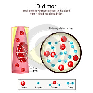 D-dimer formation. Blood vessel with blood clot