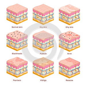 3d human skin types cross section layers. Dry, oily and normal epidermis. Skin problems, acne, blackheads, psoriasis and