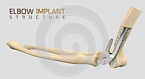 3d illustration of the endoprosthesis of the elbow joint