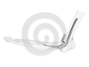 3d illustration of the endoprosthesis of the elbow joint