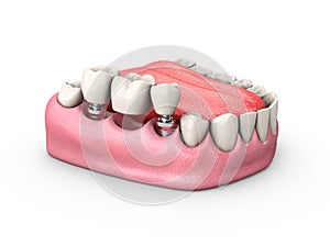 3d Illustration of a Fixed partial denture bridge, isolated white