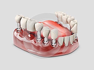 3d Illustration of a Fixed partial denture bridge, isolated white
