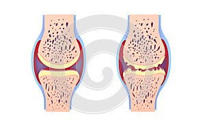 3d illustration of healthy synovial joint and with osteoarthritis. photo