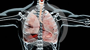 Hemopneumothorax, Normal lung versus collapsed, symptoms of Hemopneumothorax, pleural effusion photo
