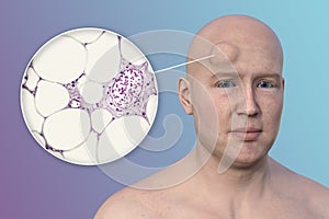 Lipoma on a man's forehead, 3D illustration and micrograph photo