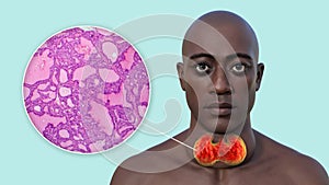 A man with enlarged thyroid gland, 3D illustration, and micrograph toxic goiter